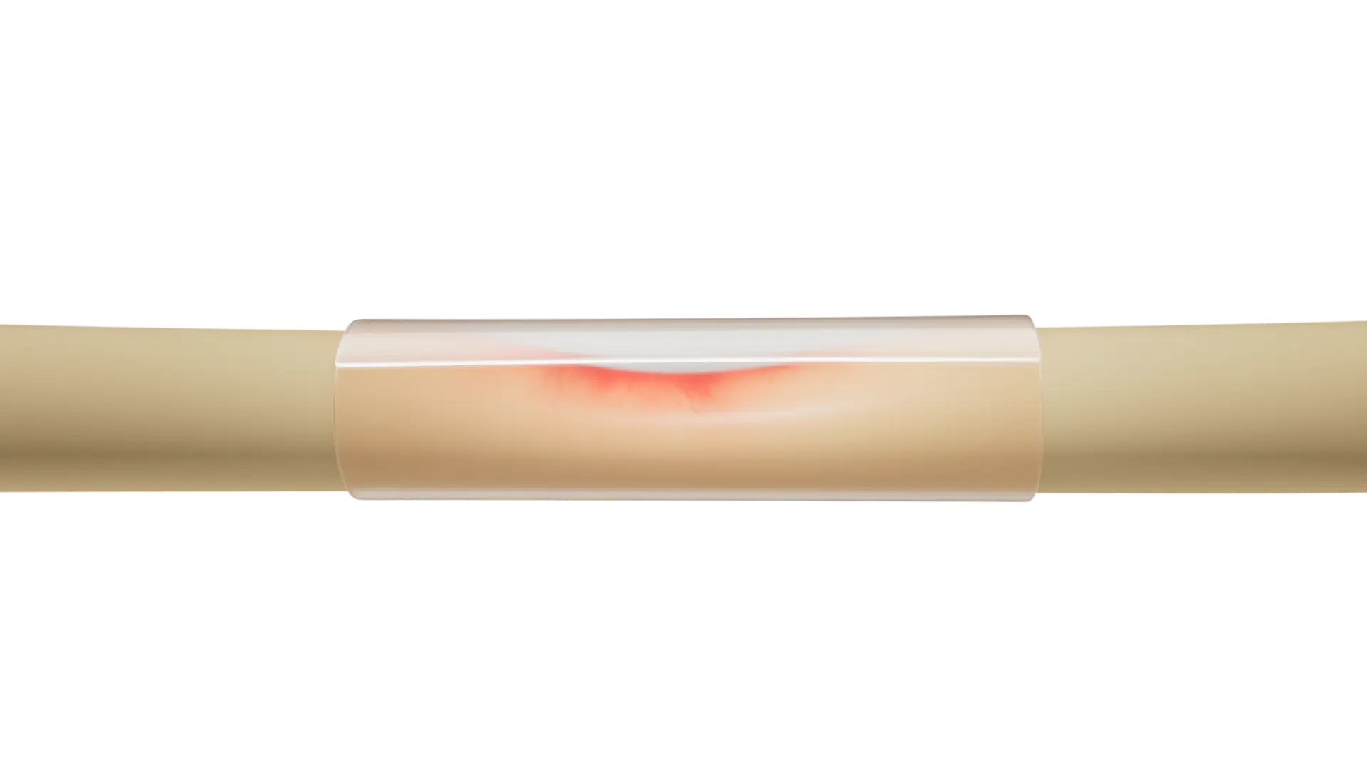 Nerve wound wrapped in 4Degra
